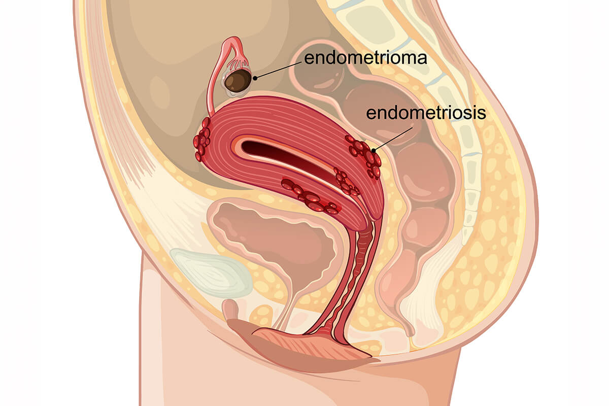 Endometriozis ve Çikolata Kisti