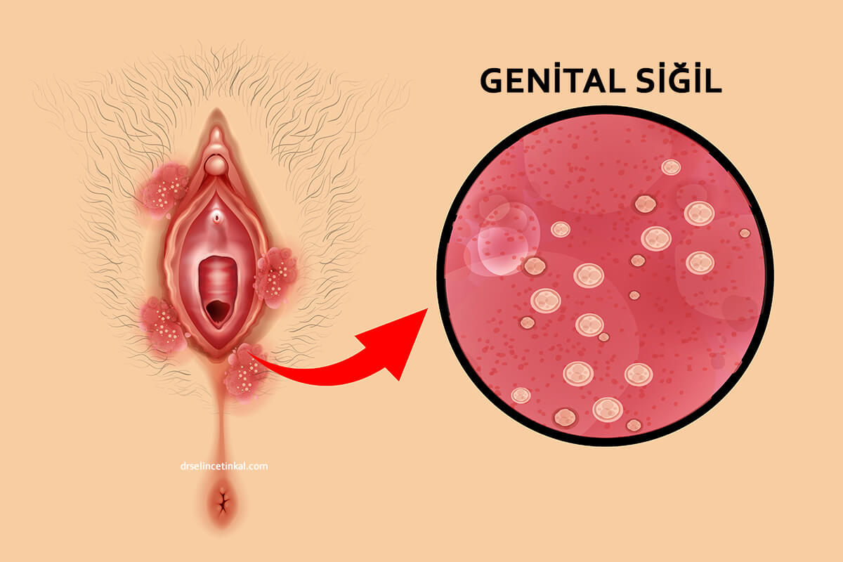 Genital Siğil