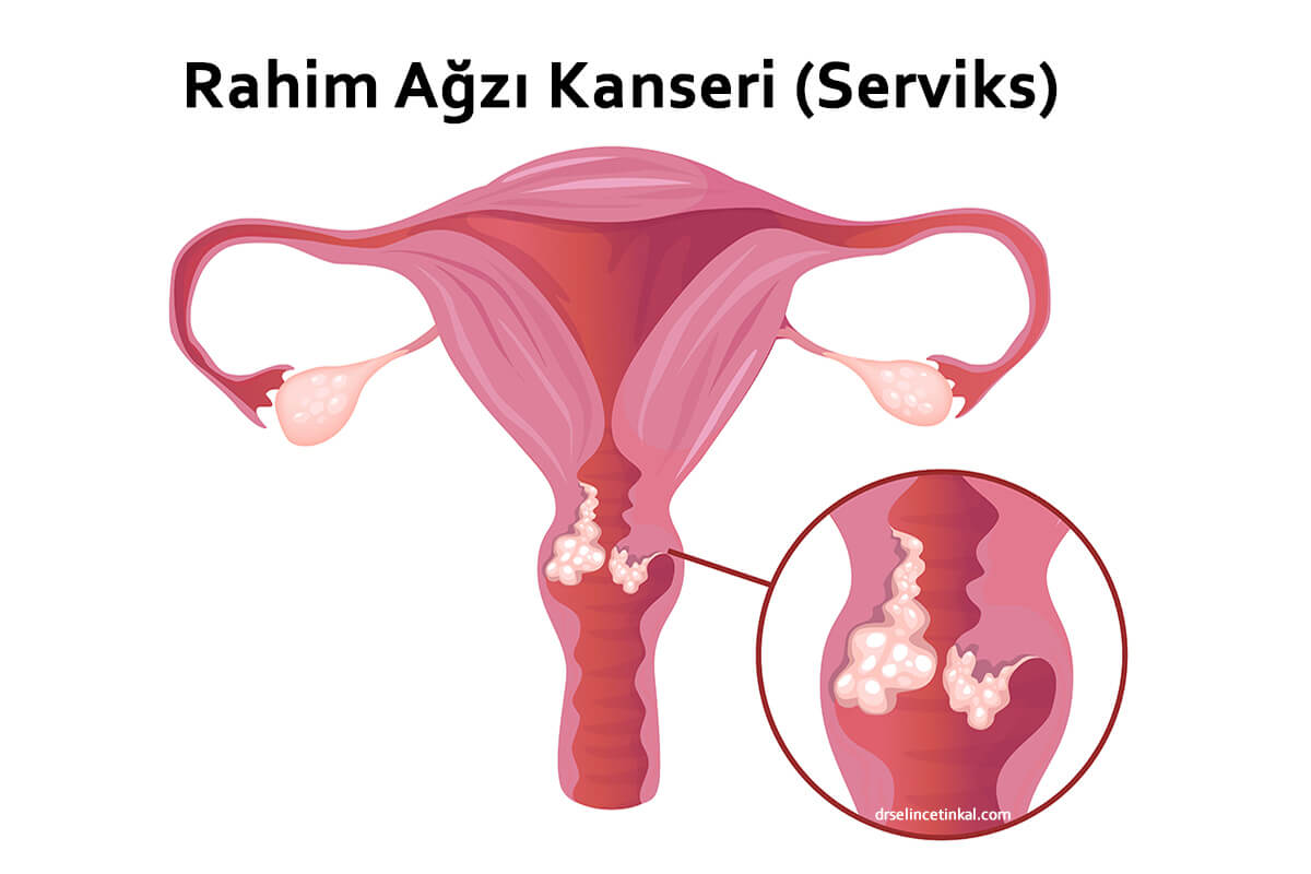 Rahim Ağzı Kanseri